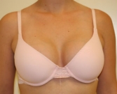 Feel Beautiful - Breast Augmentation 34a - After Photo
